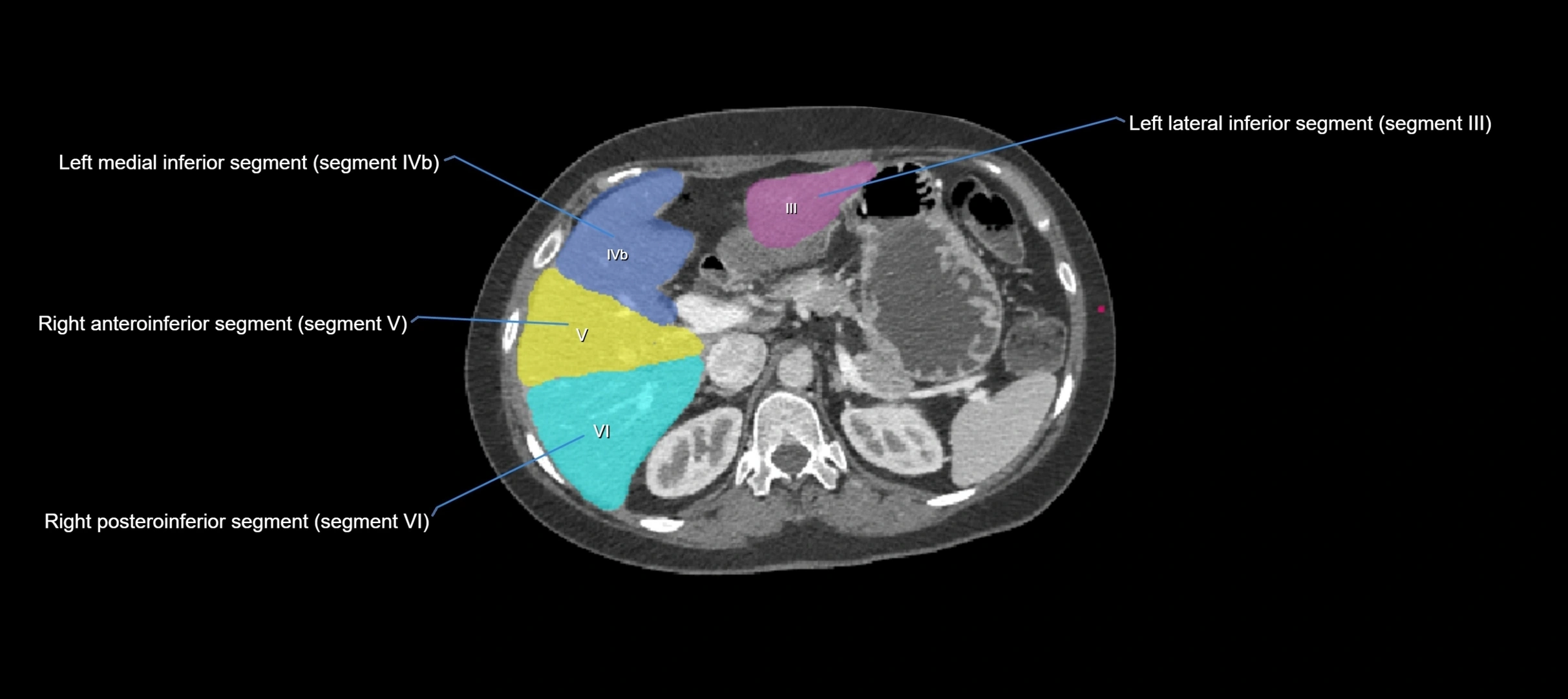 CT liver segments axial cross sectional anatomy labelled image-00043.webp